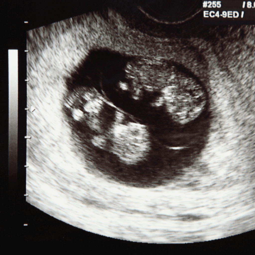 Ultrahangfelvétel ikerterhességről